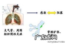无咳血肺部感染治愈,支气管扩张能自愈吗?