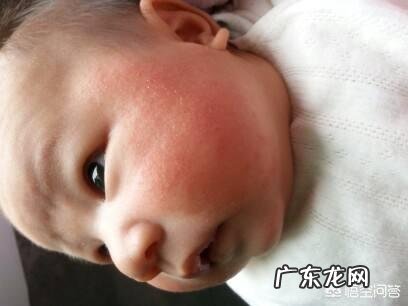 宝宝脸上出好多红点,是湿疹吗,湿疹是宝宝体内毒素吗,还是单纯的是热引起的?