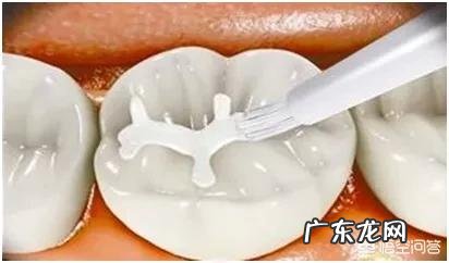 打算给儿子做窝沟封闭,请问窝沟封闭安全吗?填充材料是否无毒?