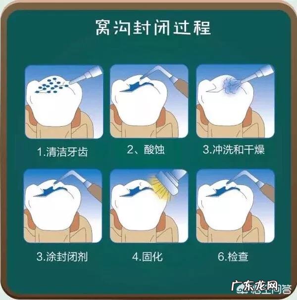 打算给儿子做窝沟封闭,请问窝沟封闭安全吗?填充材料是否无毒?