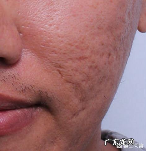 如何去除脸上的痘痘,痘印和痘坑?