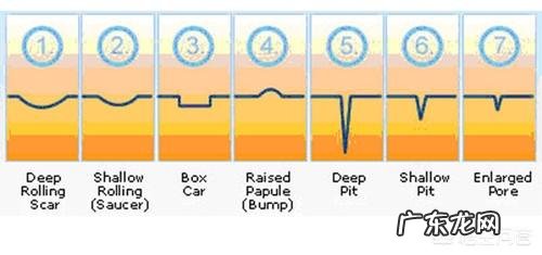 如何去除脸上的痘痘,痘印和痘坑?