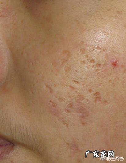 如何去除脸上的痘痘,痘印和痘坑?