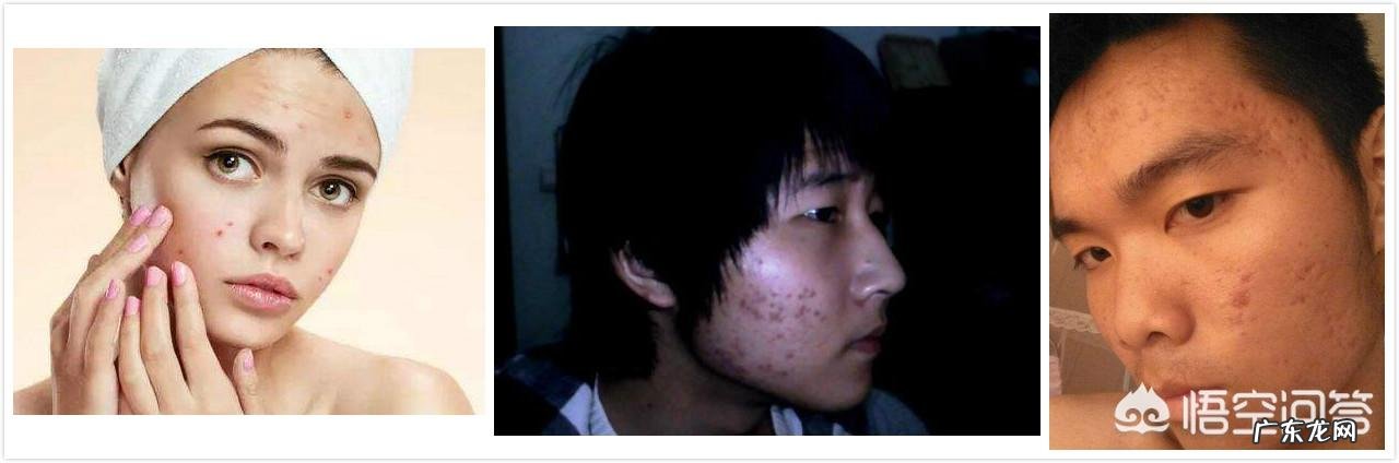 如何去除脸上的痘痘,痘印和痘坑?