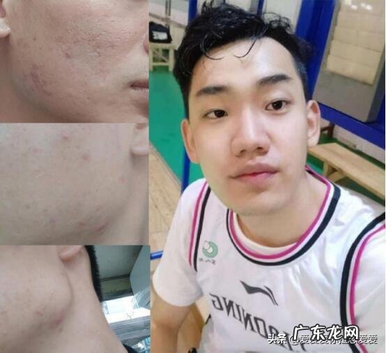 如何去除脸上的痘痘,痘印和痘坑?