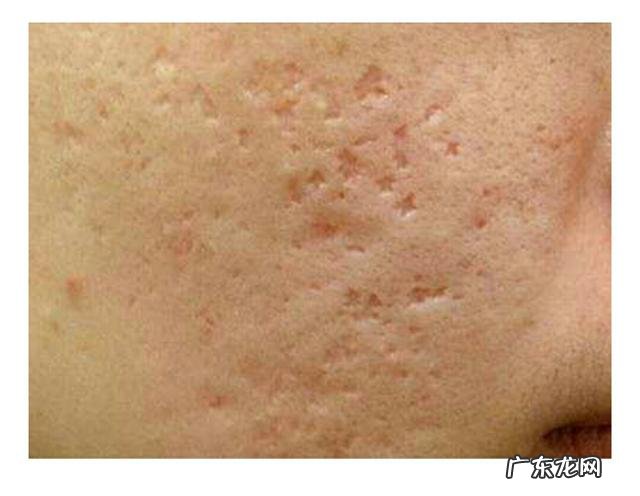 如何去除脸上的痘痘,痘印和痘坑?