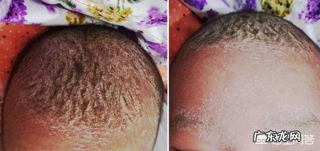 新生儿奶痂是什么?