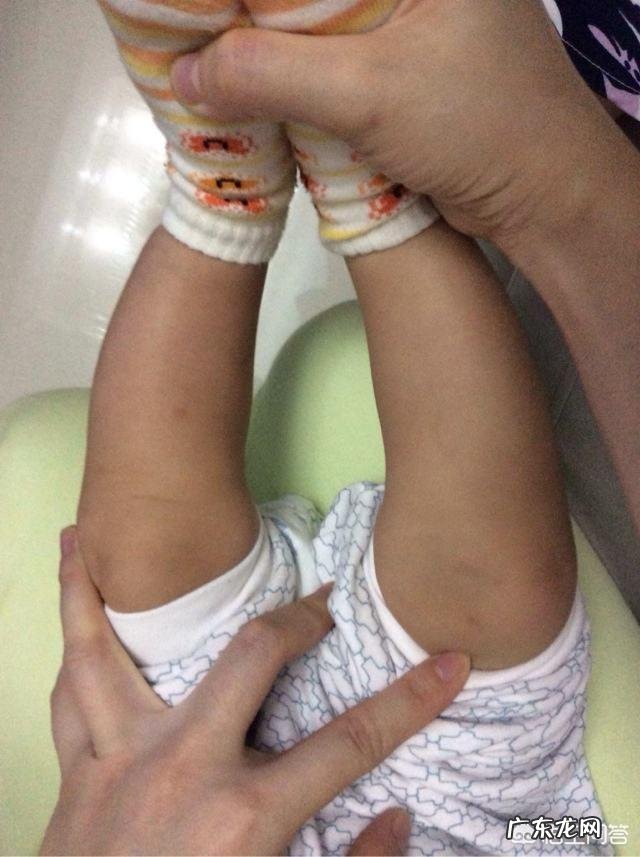 婴儿出生后要绑腿吗?