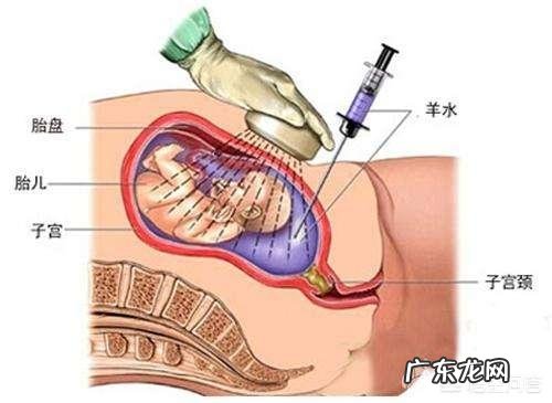 羊水穿刺有风险吗?如果大龄妈妈做这项检查,需要注意什么?