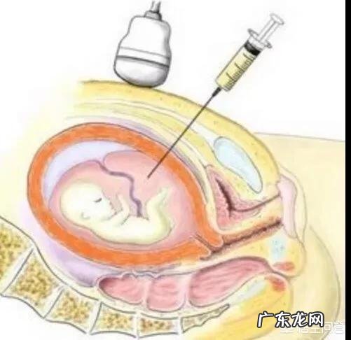 羊水穿刺有风险吗?如果大龄妈妈做这项检查,需要注意什么?