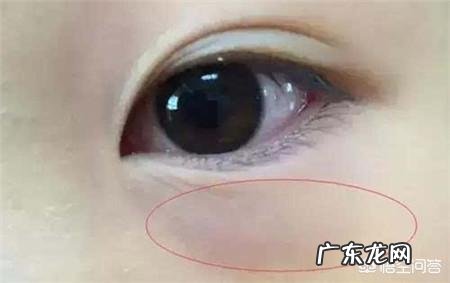 为什么眼睛有黑眼圈?