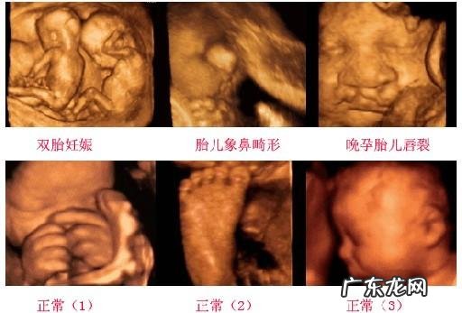 四维彩超做了有什么好处?对胎儿有影响吗?求解答,谢谢?