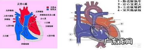 法洛四联症是什么病?