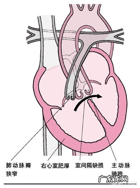 法洛四联症是什么病?