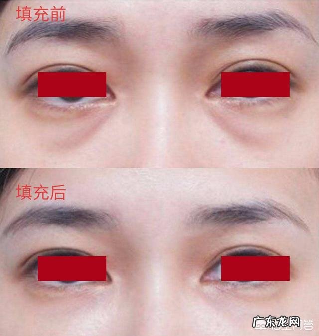 泪沟和法令纹怎么去除？