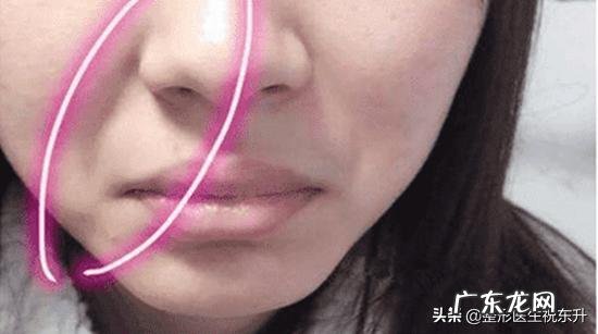 泪沟和法令纹怎么去除?