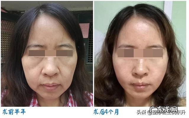 泪沟和法令纹怎么去除?