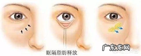 泪沟和法令纹怎么去除?