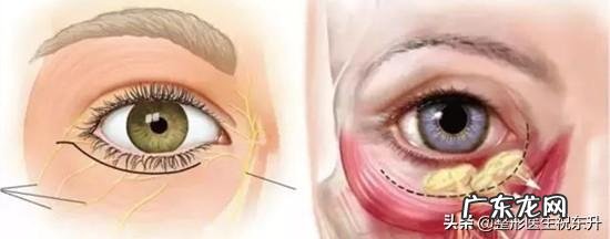 泪沟和法令纹怎么去除?