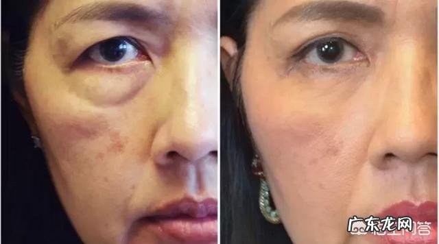 泪沟和法令纹怎么去除?