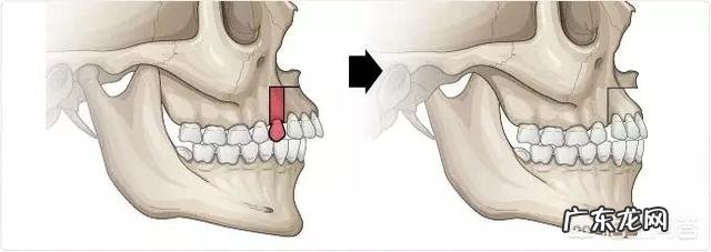 泪沟和法令纹怎么去除？