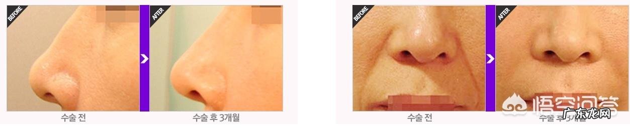 泪沟和法令纹怎么去除？