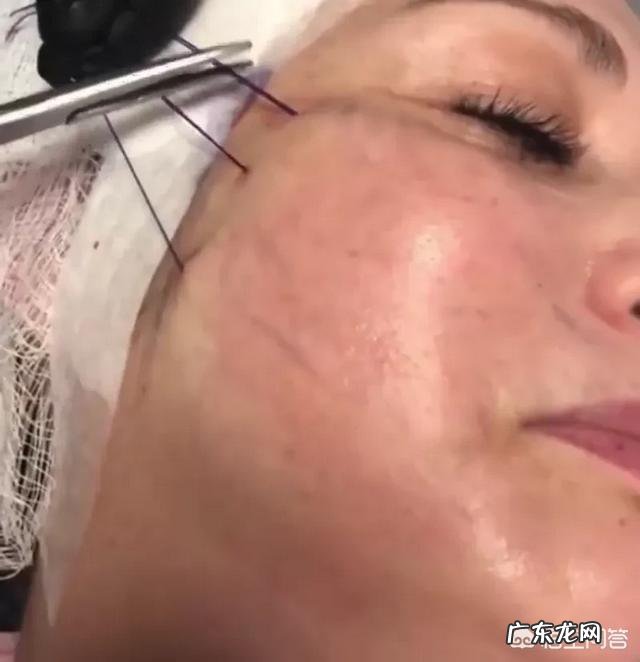 泪沟和法令纹怎么去除？