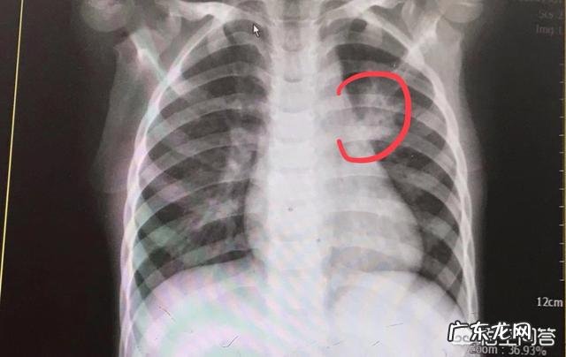 小孩咳得厉害怎么办?