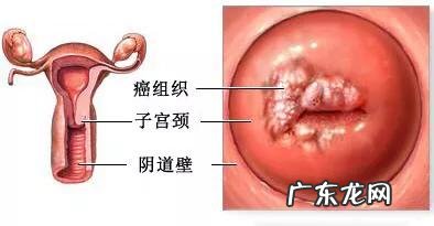 什么是宫颈癌?