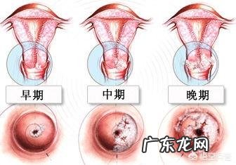 什么是宫颈癌？