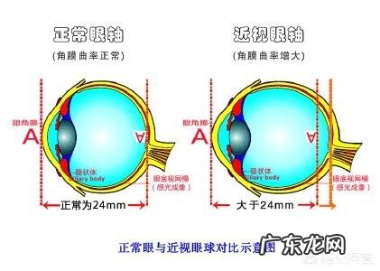 怎样挽救因长时间戴眼镜而变形的眼睛？