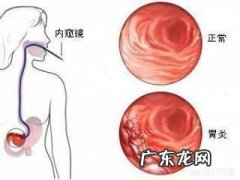 功能性消化不良和慢性非萎缩性胃炎有什么区别？