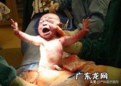 准备剖腹产，多少周剖比较好？等发动了再去还是可以提前？产后有哪些注意事项？