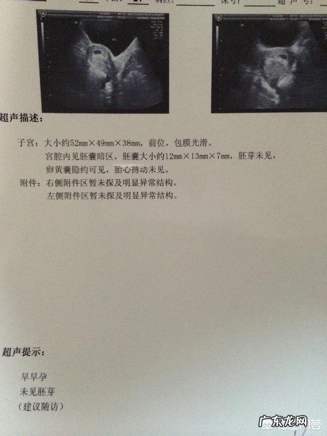 怀孕40天去做B超,可以检查出什么?