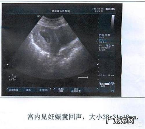 怀孕40天去做B超，可以检查出什么？