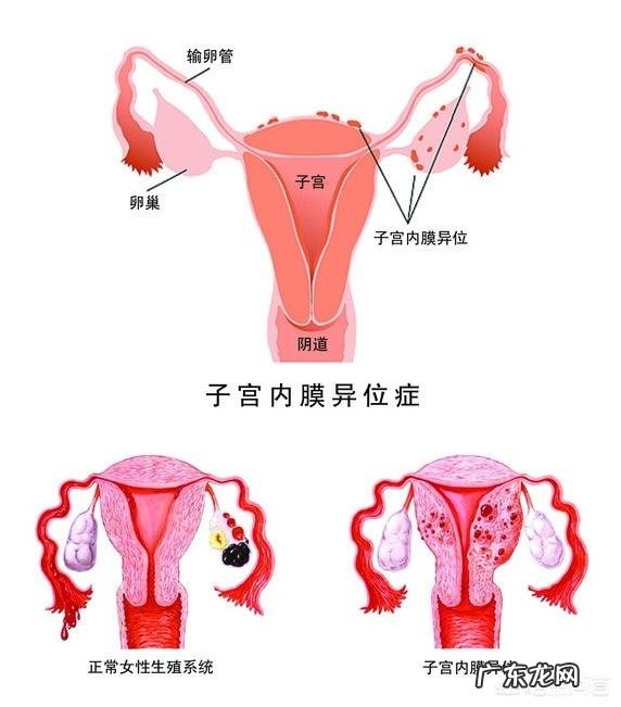 子宫内膜异位症该怎么治疗？