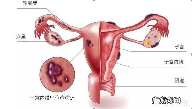 子宫内膜异位症该怎么治疗？
