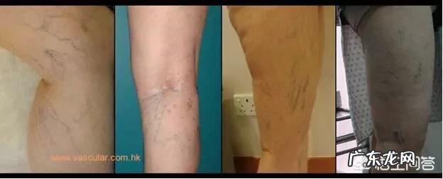腿上的红血丝该怎么消除？