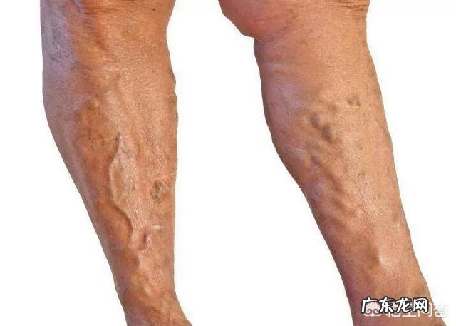 腿上的红血丝该怎么消除?