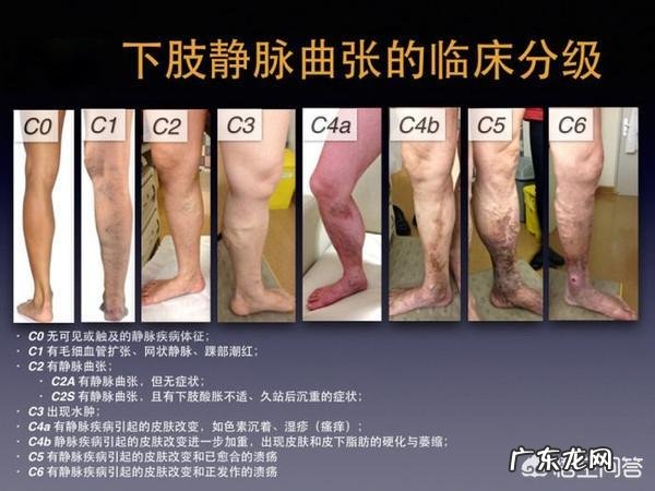 腿上的红血丝该怎么消除？