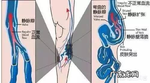 腿上的红血丝该怎么消除?