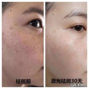 怎样祛斑最快最有效？