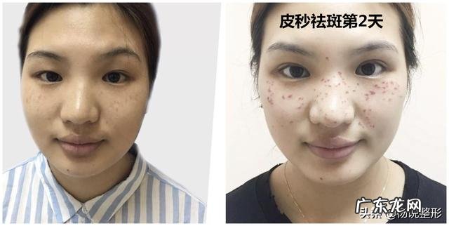 怎样祛斑最快最有效?