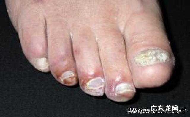 “老寒腿”只是因为“寒”吗?