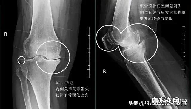 “老寒腿”只是因为“寒”吗？