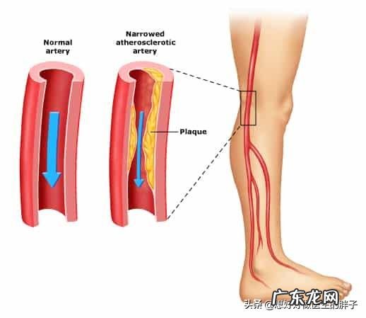“老寒腿”只是因为“寒”吗？