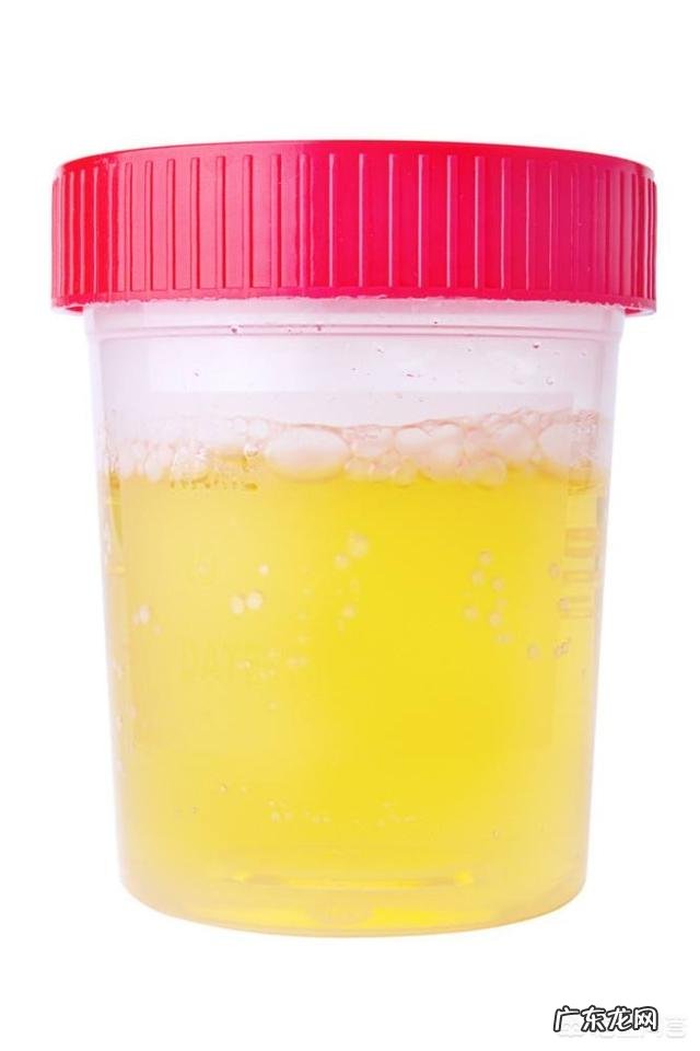 检查尿常规需要注意什么?