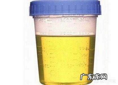 检查尿常规需要注意什么?