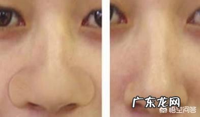 鼻子又大又塌,我该怎么办?