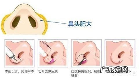 鼻子又大又塌,我该怎么办?